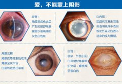 障福明 消朦片36片 角膜白斑白内障明目